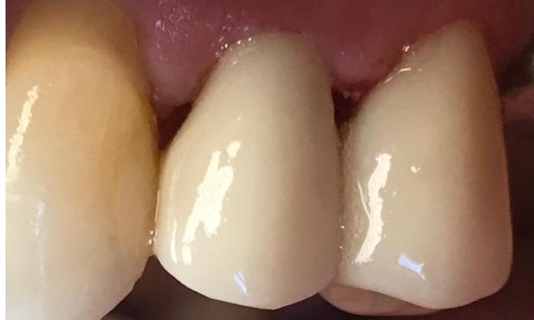 Close up of two teeth with brand new dental crowns