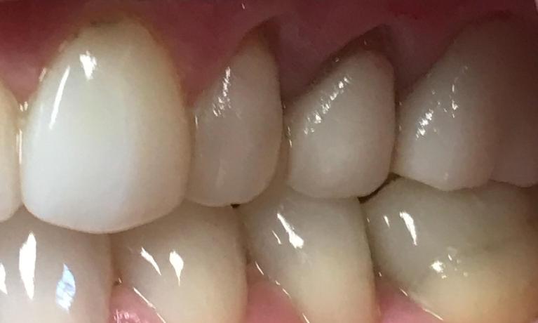 Close up of a row of discolored teeth