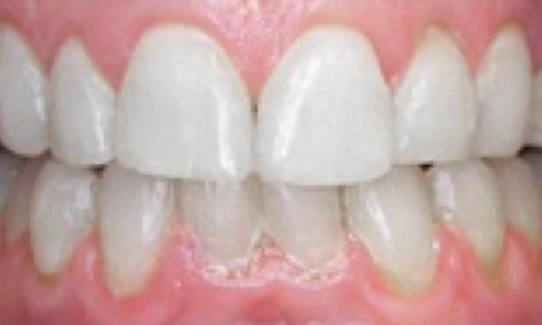 Close up of straight even teeth after Invisalign treatment
