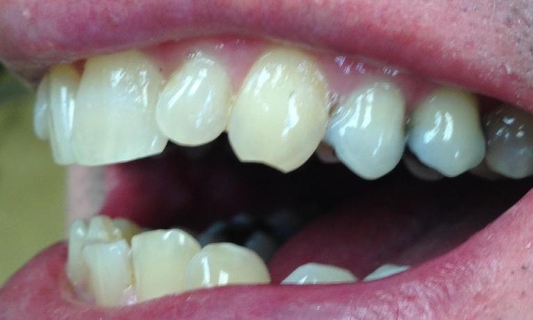 Side view of a person with crooked teeth before Invisalign
