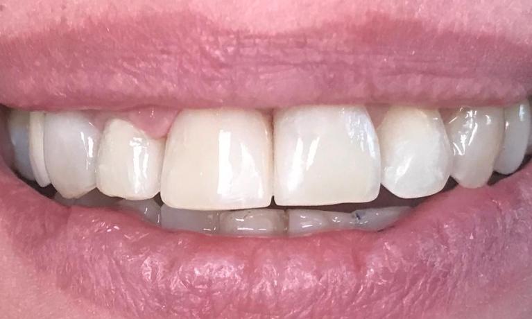 Close up of a person with their teeth fixed after a smile makeover