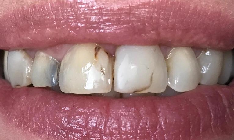 Close up of a person with cracked and discolored teeth