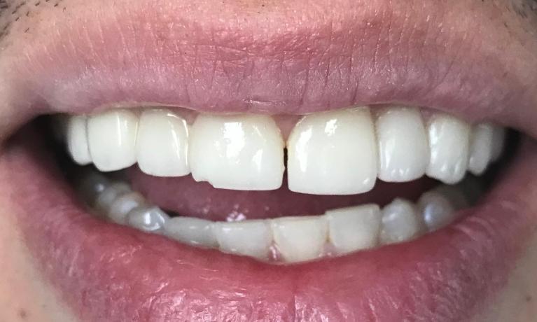 Close up of person smiling before getting a dental veneer repaired