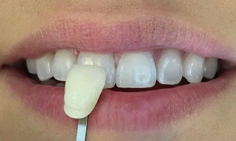 Shade guide being held up to smile with dull colored teeth