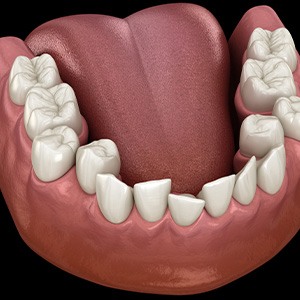 Illustration of crooked teeth