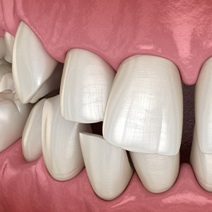Illustration of gapped teeth