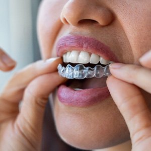 Closeup of patient putting on clear aligner