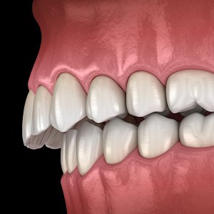 Illustration of an overbite