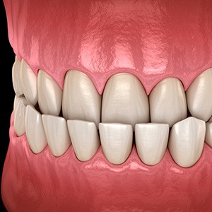 Illustration of an underbite