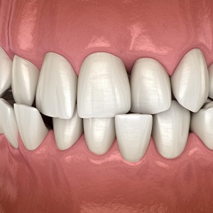 Illustration of a crossbite