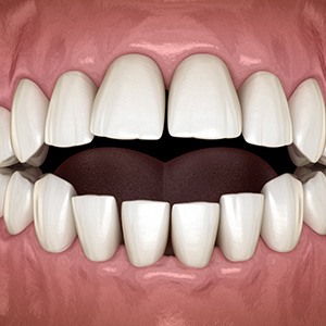 Illustration of an open bite