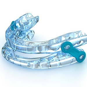 An oral sleep apnea appliance