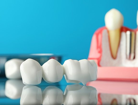 A dental bridge near an educational gum model with a dental implant