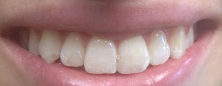 Close up of a person with flawless teeth after a smile makeover in West Caldwell
