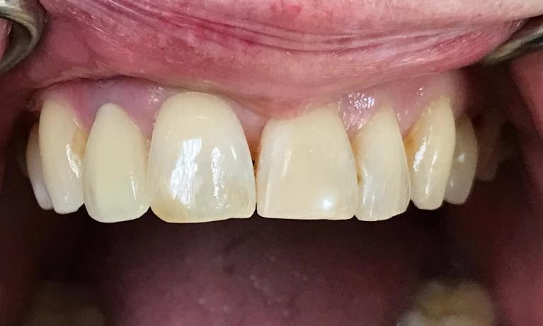 Close up of a person after getting their chipped tooth fixed