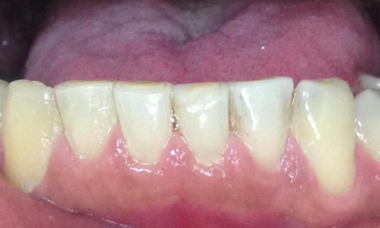 Close up of a flawless lower tooth after cosmetic dental bonding