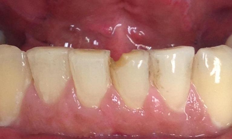 Close up of a chipped lower tooth