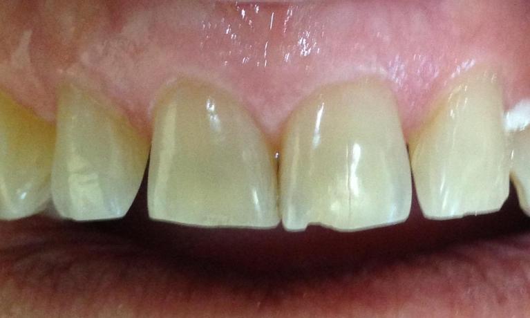 Zoomed in view of a chipped upper tooth