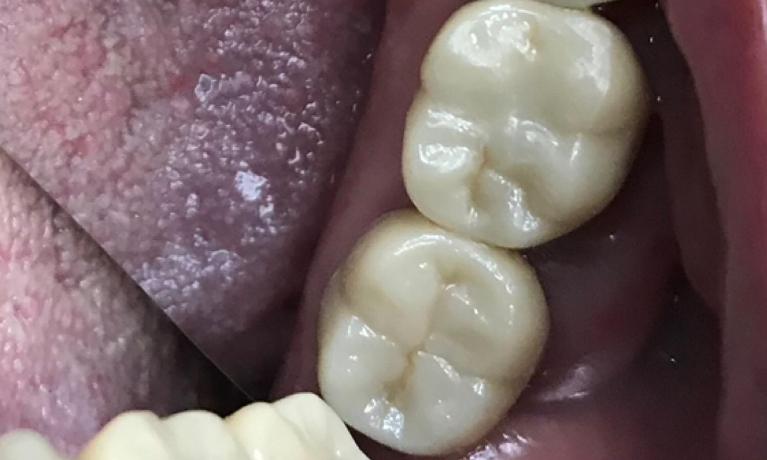 Close up of teeth with two dental crowns in West Caldwell