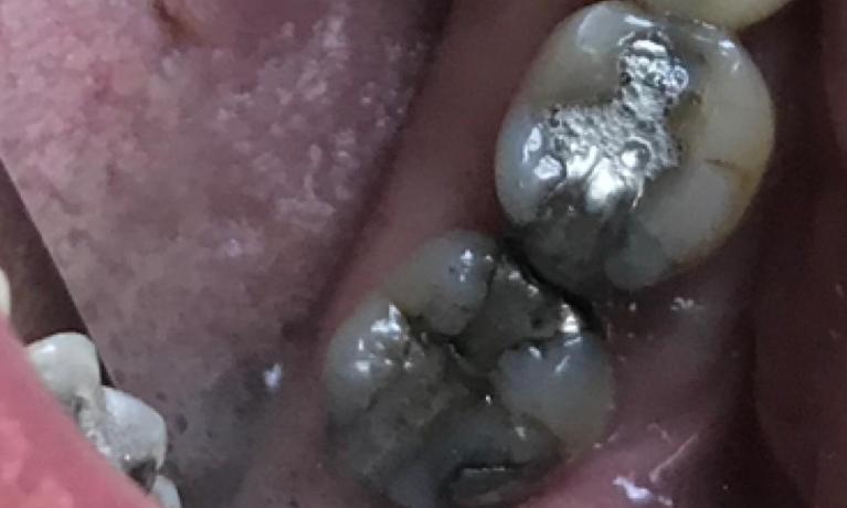 Close up of two teeth with dark gray metal fillings