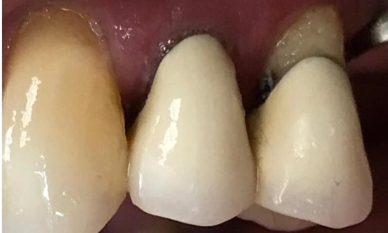 Close up of two teeth with old failing dental crowns