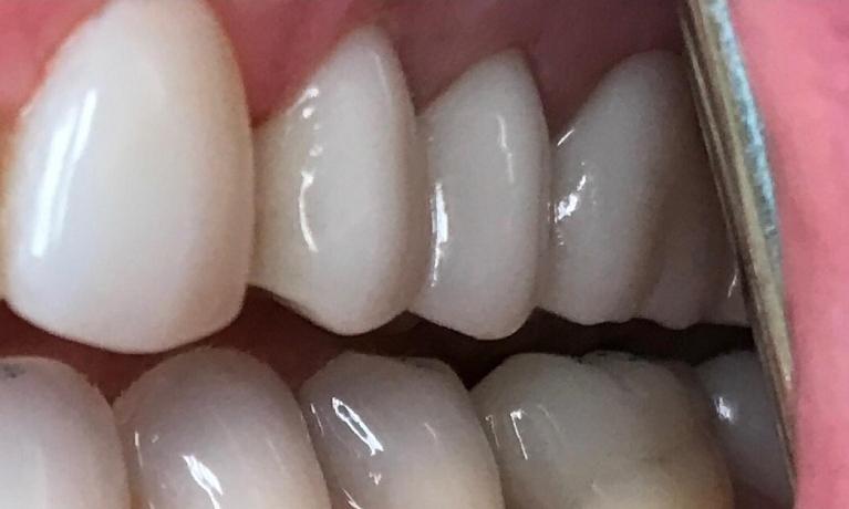 Close up of a row of flawless teeth with dental crowns
