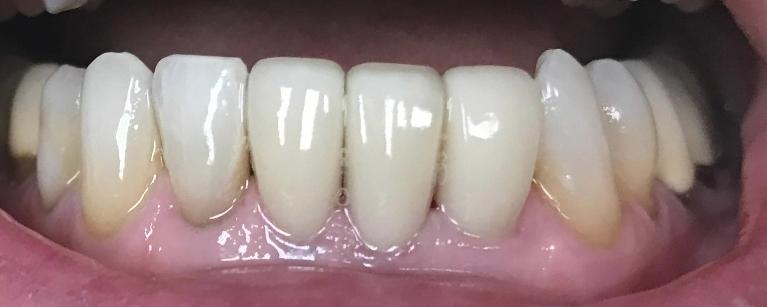 Close up of row of flawless lower teeth with dental crowns