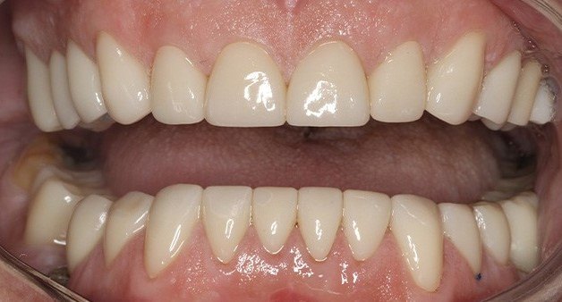 Close up of row of flawless lower teeth with dental crowns