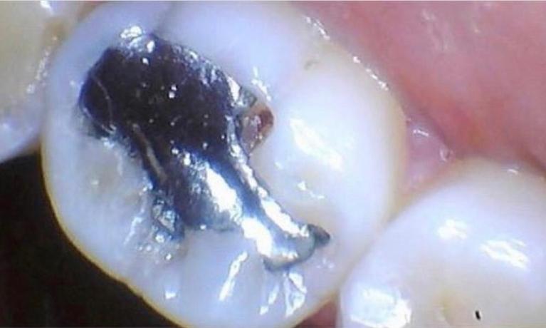 Tooth with a dark gray metal filling