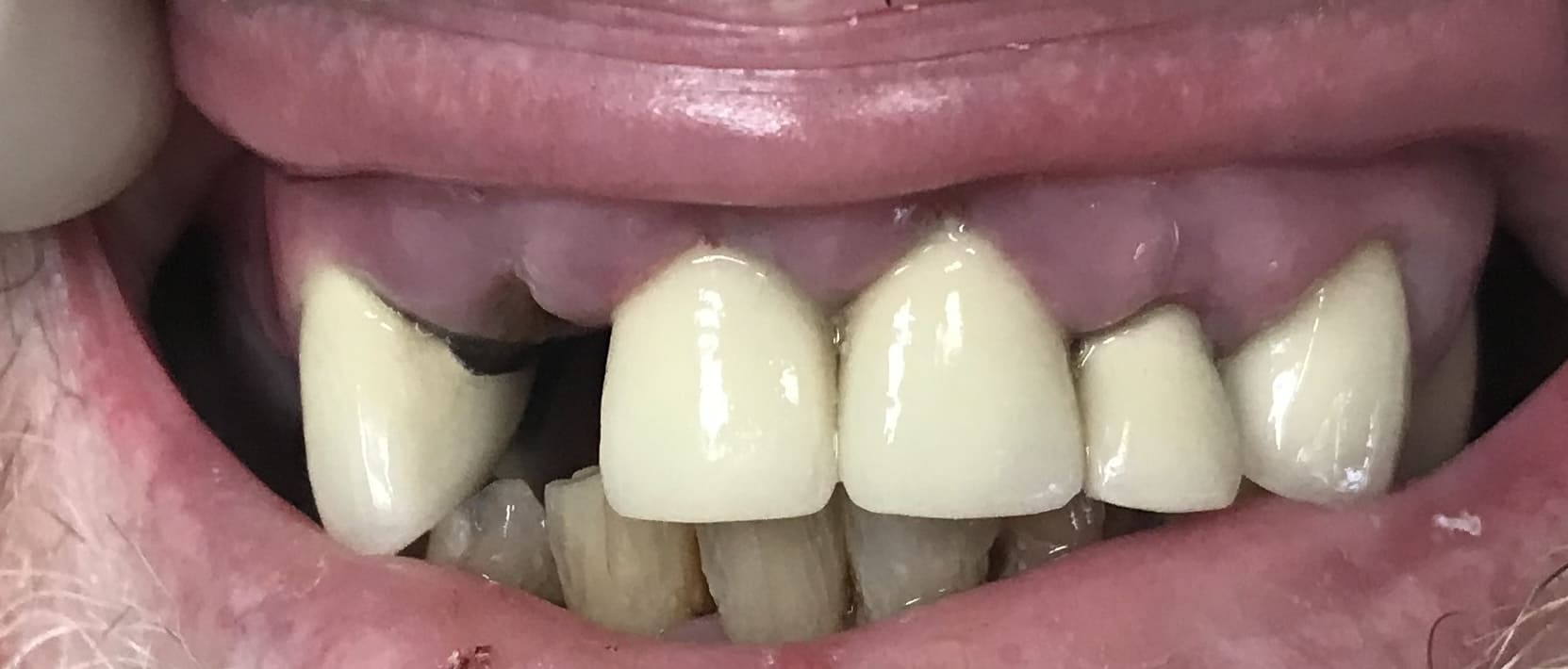 Close up of a mouth with some missing teeth