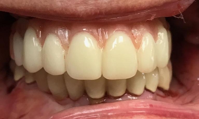 Close up of a person with a complete set of teeth thanks to dental implants