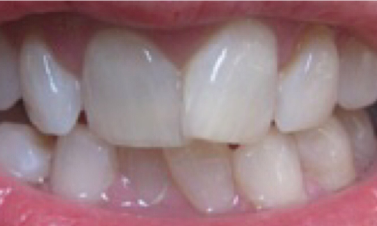 Close up of a person with overlapping teeth