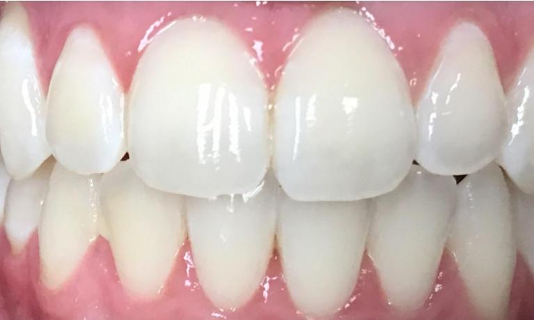 Well aligned teeth after Invisalign treatment