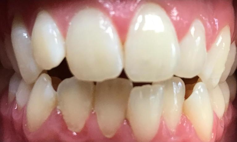 Close up of a person with crowded teeth