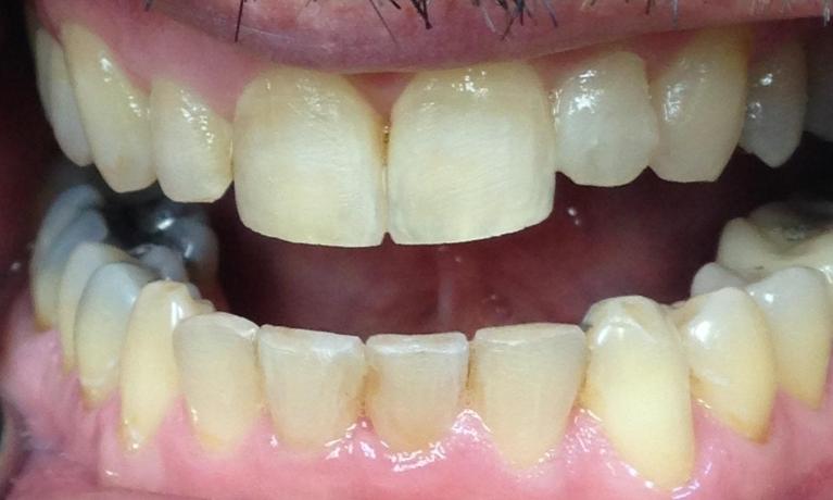 Close up of person with straight teeth after Invisalign
