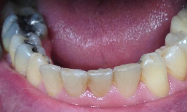 Close up of the bottom row of teeth of an Invisalign patient