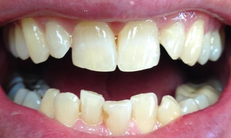 Close up of a person with crooked teeth before Invisalign in West Caldwell
