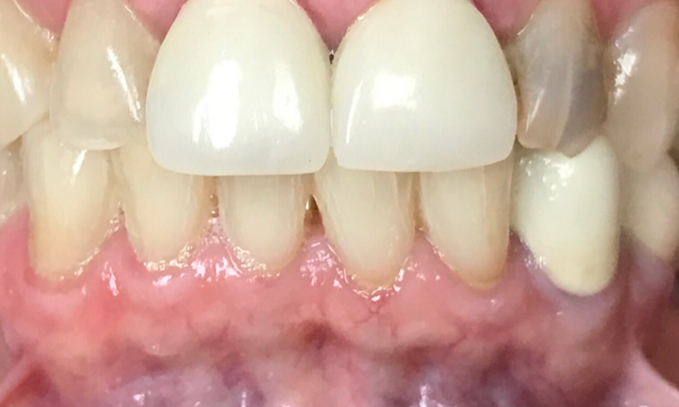 Close up of person with discolored teeth