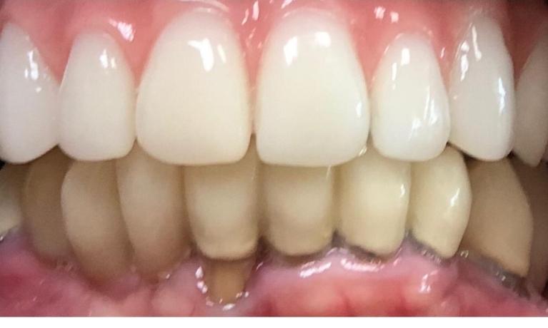 Close up of flawless teeth thanks to dental implants