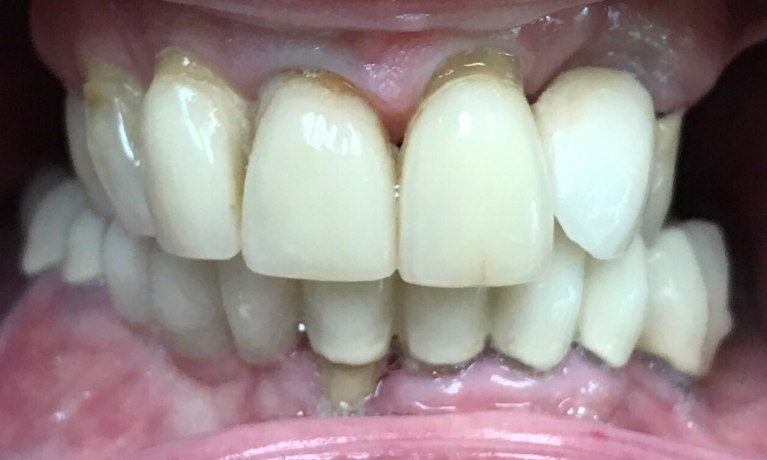 Close up of imperfect teeth