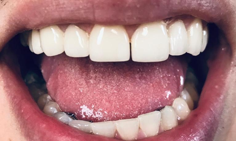 Close up of a person grinning after getting their veneer repaired