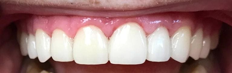 Close up of brighter teeth after treatment with veneers in West Caldwell