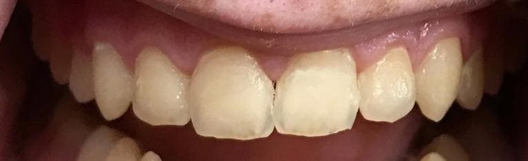 Close up of person smiling with discolored teeth