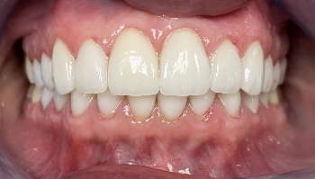 Close up of smile with flawless teeth after getting veneers in West Caldwell