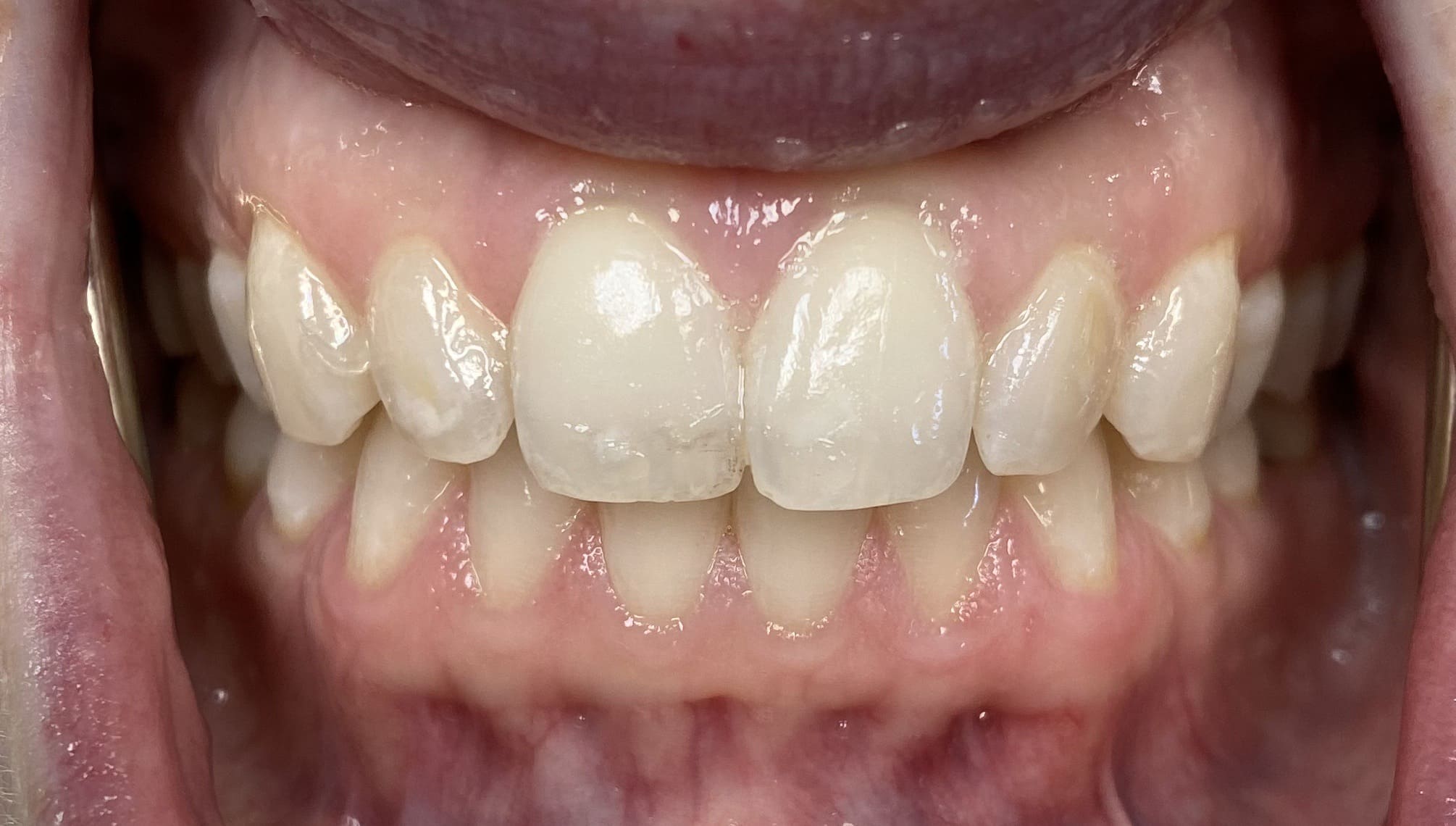 Close up of person smiling with discolored teeth