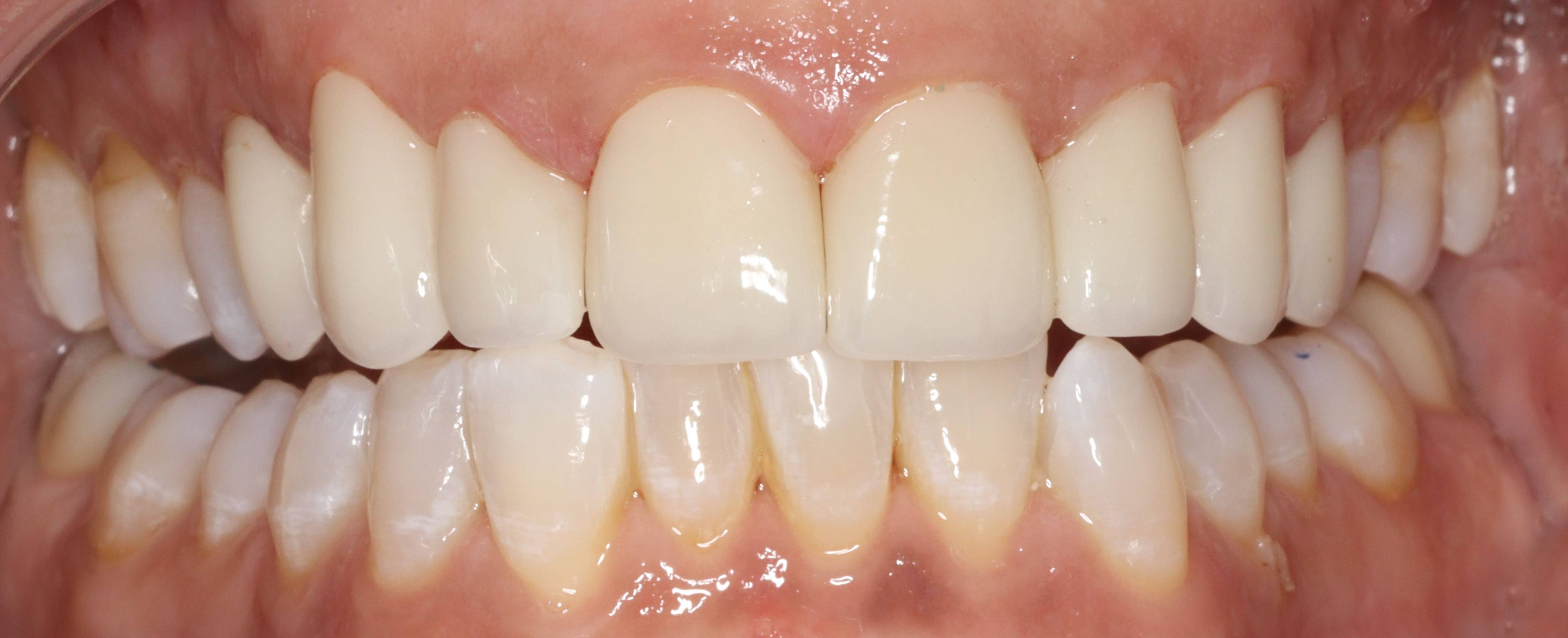 Close up of smile with flawless teeth after getting veneers in West Caldwell
