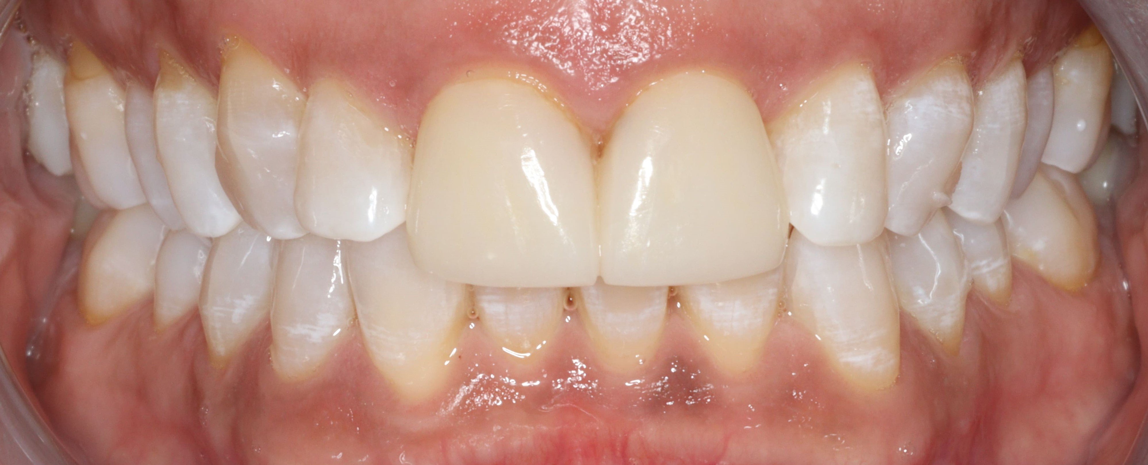 Close up of person smiling with discolored teeth