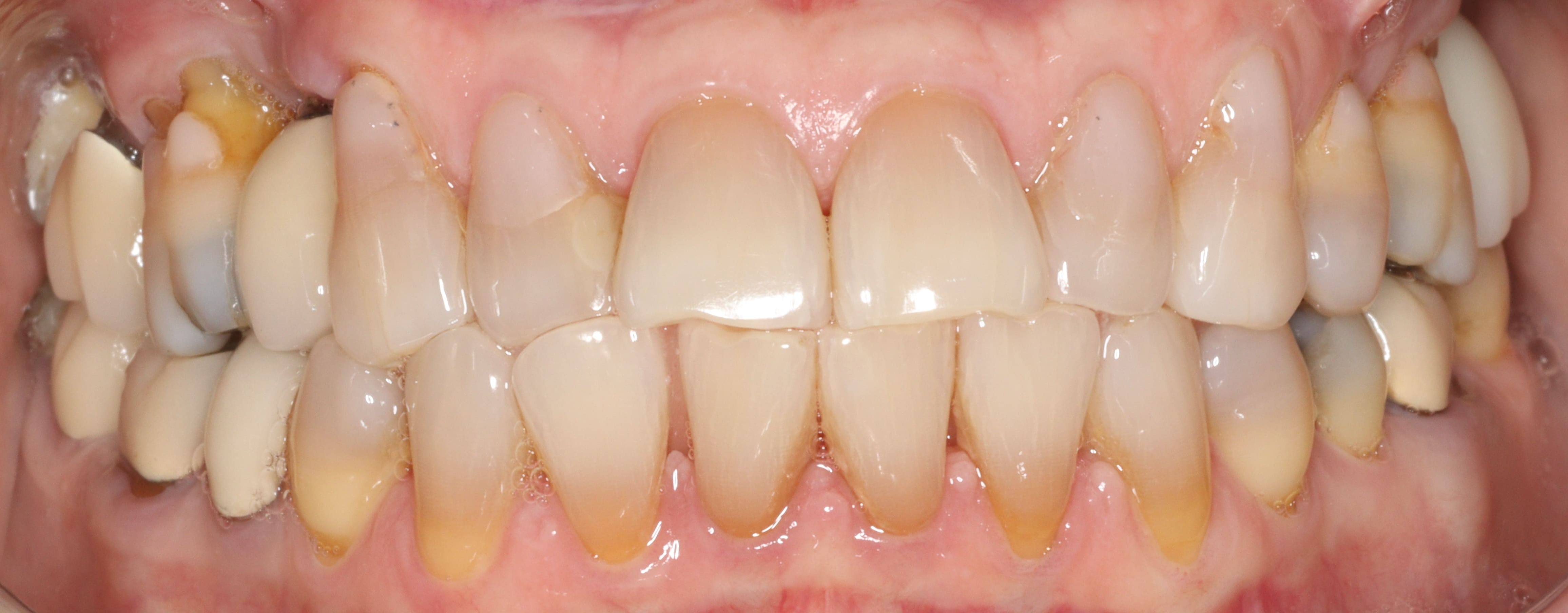 Close up of person smiling with discolored teeth