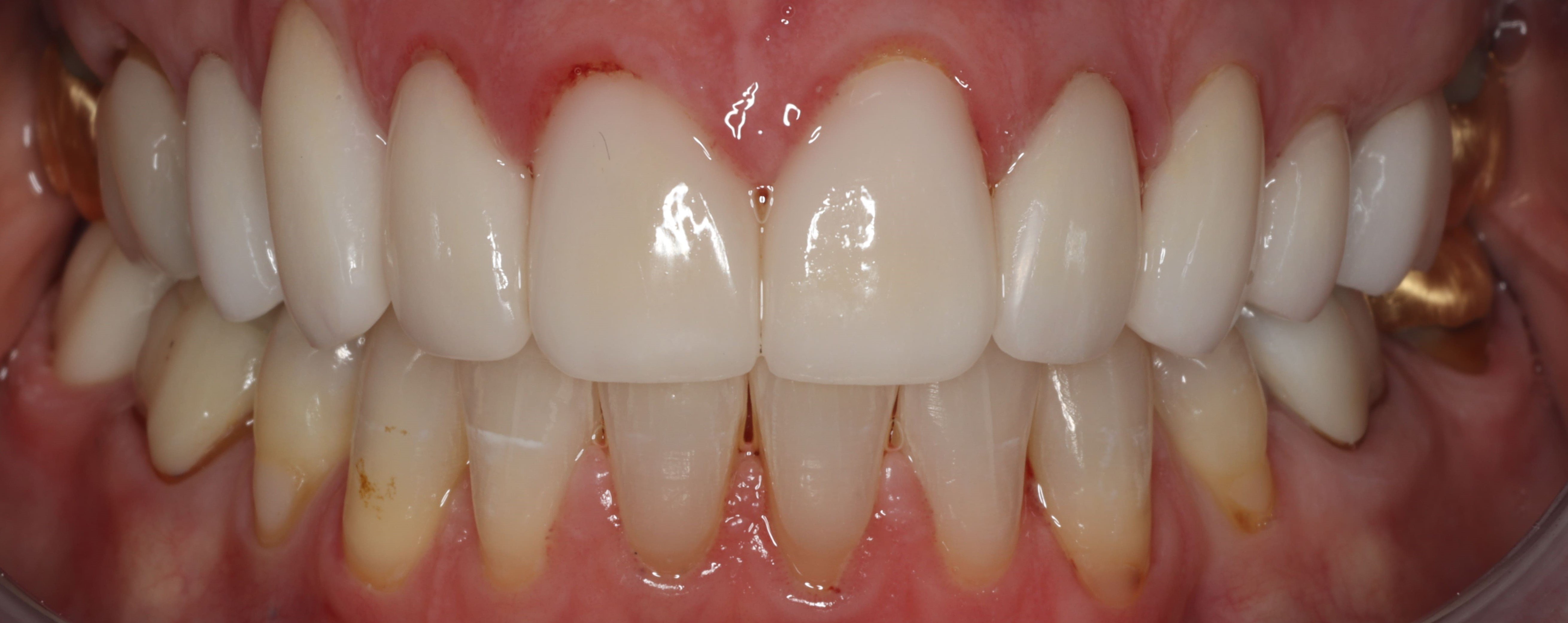 Close up of smile with flawless teeth after getting veneers in West Caldwell