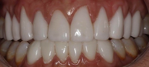 Close up of person grinning after getting dental veneer repaired